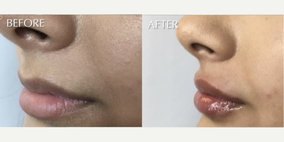 Lip Fillers before and after photo