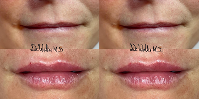 Lip Fillers before and after photo