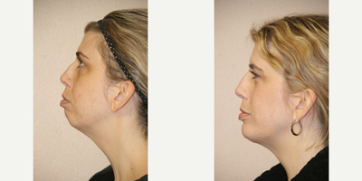 Chin Implant before and after photo