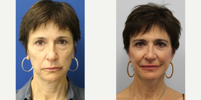 Facelift before and after photo
