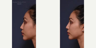 Juvederm before and after photo