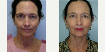 Neck Lift before and after photo