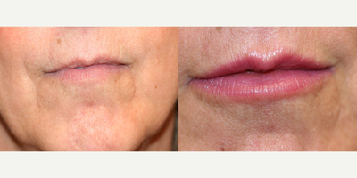 Restylane before and after photo