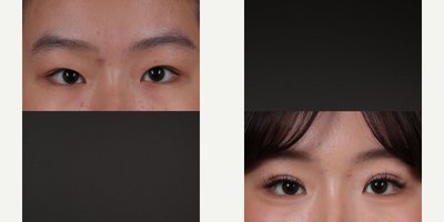 Eyelid Surgery before and after photo