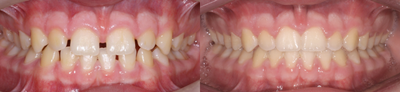 Invisalign before and after photo