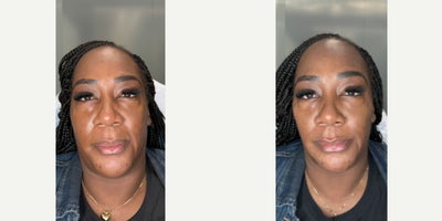 Lip Fillers before and after photo