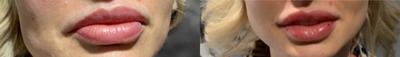Dermal Fillers before and after photo
