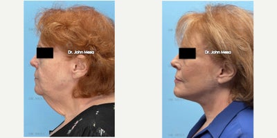 Neck Lift before and after photo