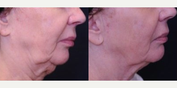 Profound RF before and after photo