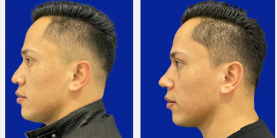 Rhinoplasty before and after photo