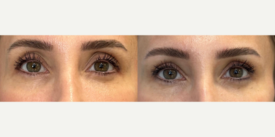 Dermal Fillers before and after photo