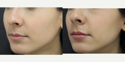 Lip Fillers before and after photo