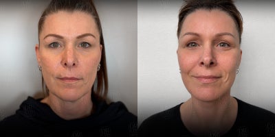 Neck Lift before and after photo