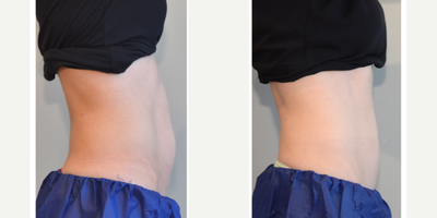 CoolSculpting before and after photo