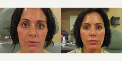 Dermal Fillers before and after photo