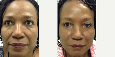 Dermal Fillers before and after photo