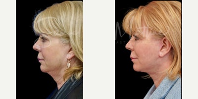 before and after image