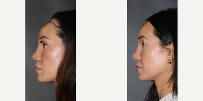 Forehead Reduction before and after photo