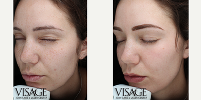 Halo Laser before and after photo