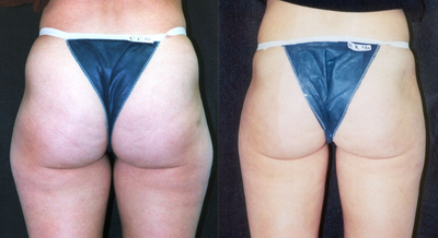 Liposuction before and after photo