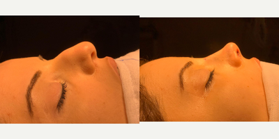 Rhinoplasty before and after photo