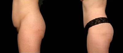 Tummy Tuck before and after photo