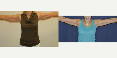 Arm Lift before and after photo