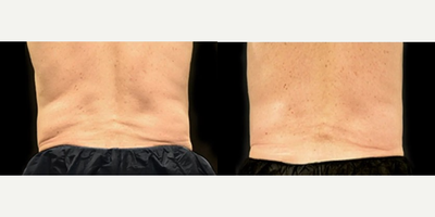 CoolSculpting before and after photo