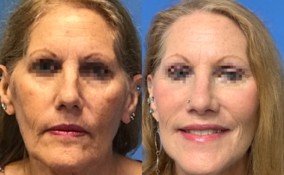 Facelift before and after photo