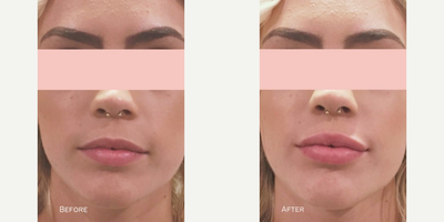 Lip Fillers before and after photo