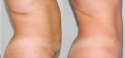 Tummy Tuck before and after photo