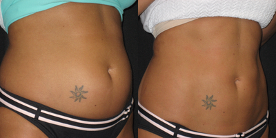 CoolSculpting before and after photo