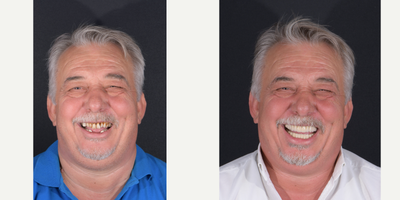 Dental Crown before and after photo