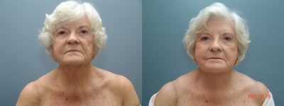 Facelift before and after photo
