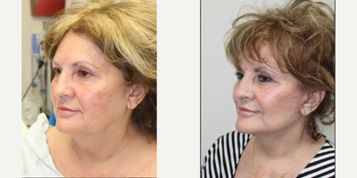 Facelift before and after photo