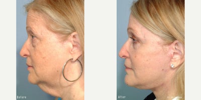 Facelift before and after photo
