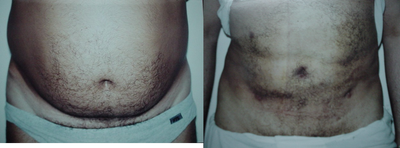 Liposuction before and after photo