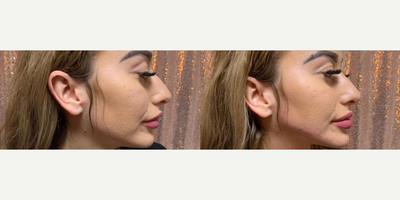 Nonsurgical Facelift before and after photo