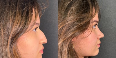 Rhinoplasty before and after photo