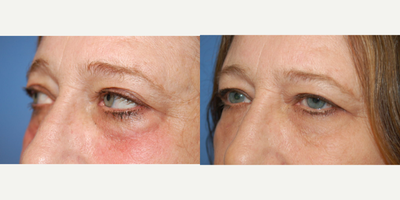 Belotero before and after photo