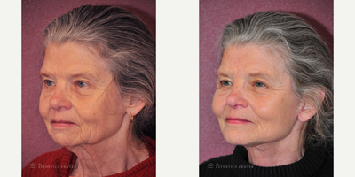 Chin Implant before and after photo