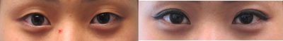 Double Eyelid Surgery before and after photo