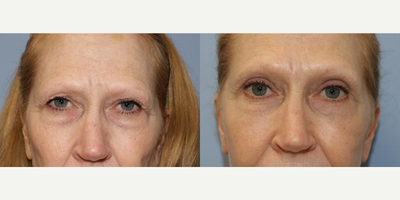 Eyelid Surgery before and after photo