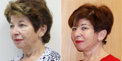 Facelift before and after photo