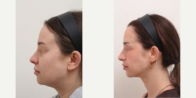 Nonsurgical Facelift before and after photo