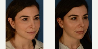 Revision Rhinoplasty before and after photo