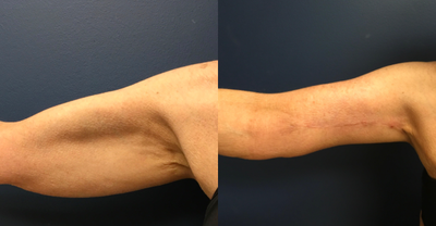 Arm Lift before and after photo