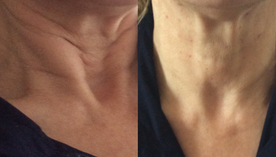 Botox before and after photo