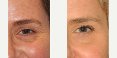 Botox before and after photo