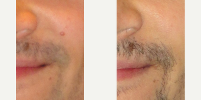 Mole Removal before and after photo